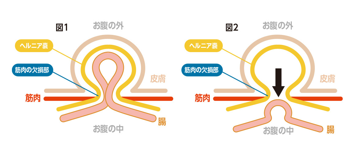 鼠径部ヘルニアとは｜KENクリニック