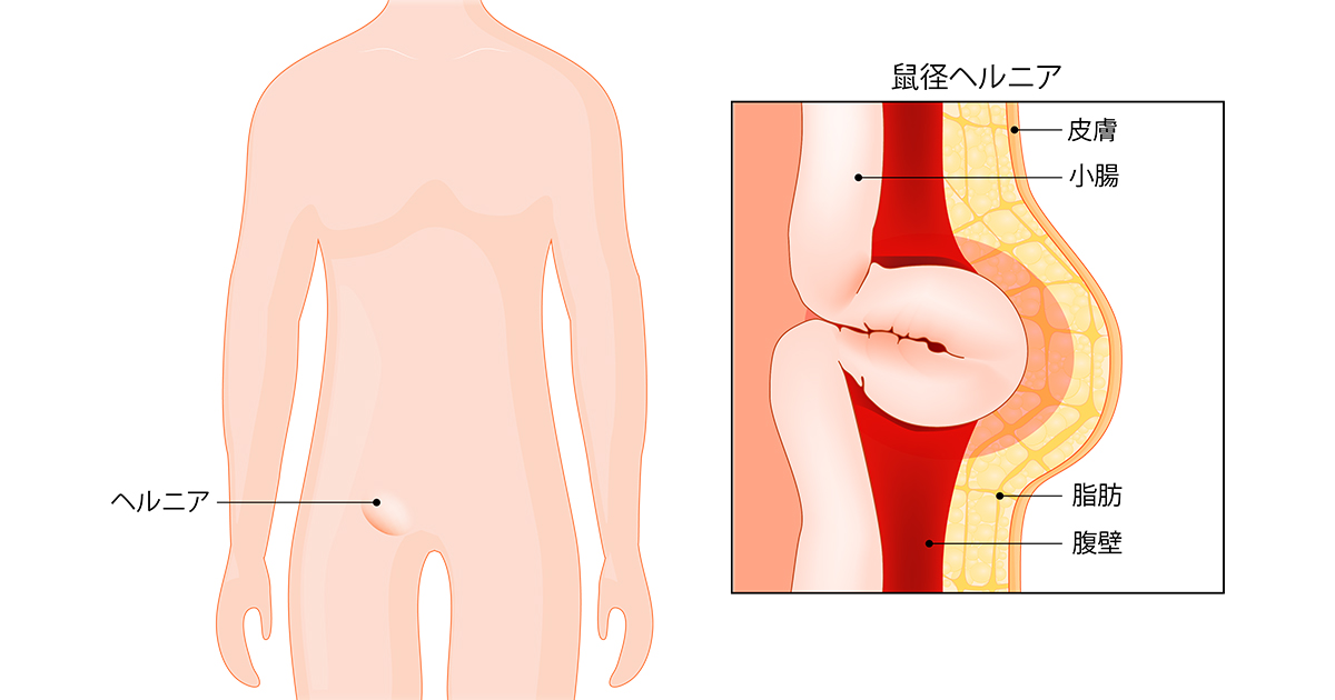 鼠径ヘルニア