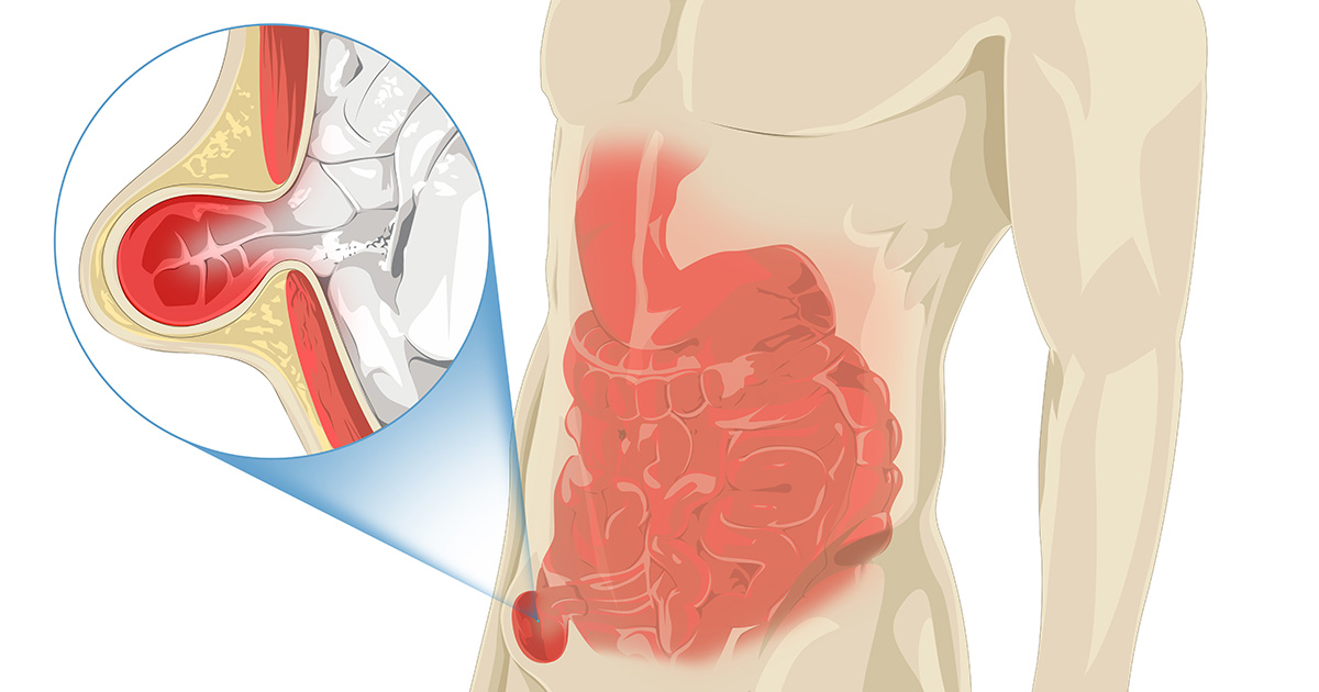 鼠径ヘルニアの嵌頓